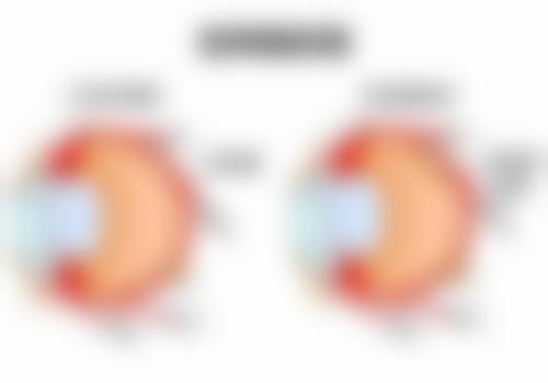核心项目解析:精细定制,守护角膜与视力